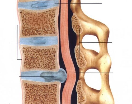 The hernia are pronounced