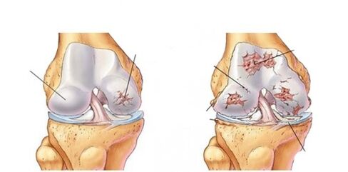 deforming osteoarthritis of the knee