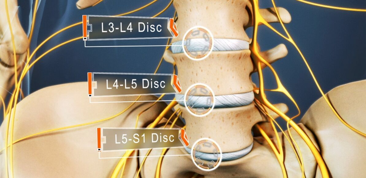 Intervertebral discs of the lumbar spine, which are most often affected in osteochondrosis