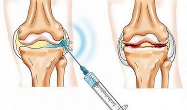 The blockade of the knee joint for osteoarthritis