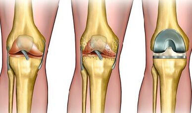 The degree of development of the arthrosis of the knee joint
