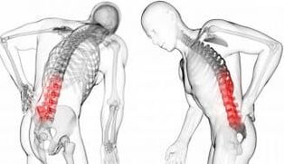 Intermediate vertebral hernia - complication with osteochondrosis