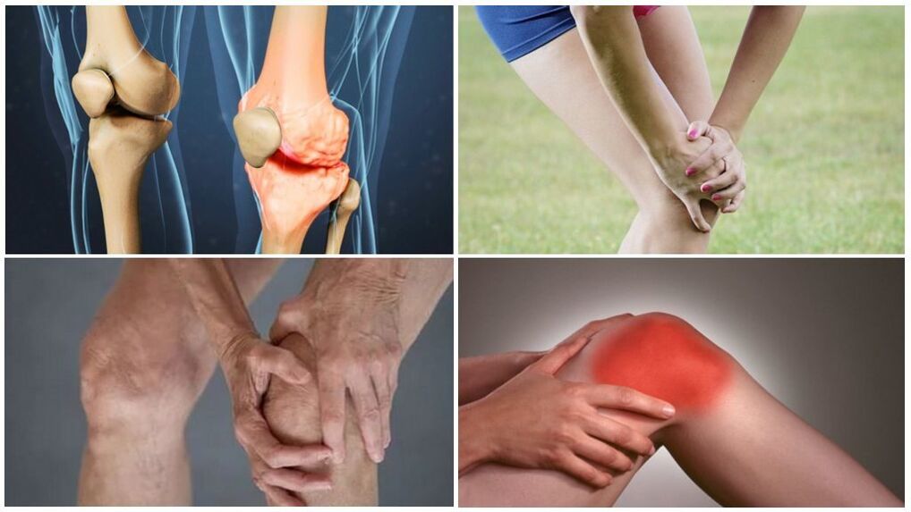 Arthrosis stadiums