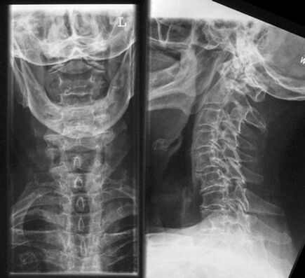 Cervical X -Ray diagnosis of osteochondrosis method