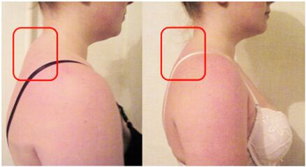 Formation of muscle rolls with cervical osteochondrosis