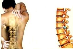 Back pain in different stages of the development of cervical osteochondrosis