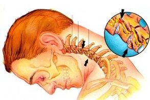 Clamping the nerve in the spine with cervical osteochondrosis