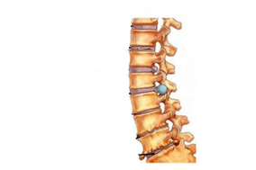 Damage to the spine with cervical osteochondrosis