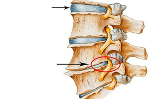 Normal and damaged spine with cervical osteochondrosis
