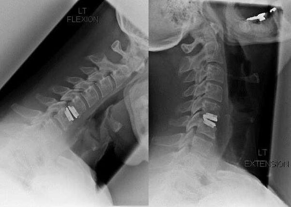 Image of the spine after surgery
