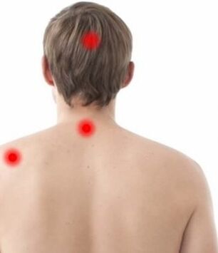 Location of pain in cervical osteochondrosis