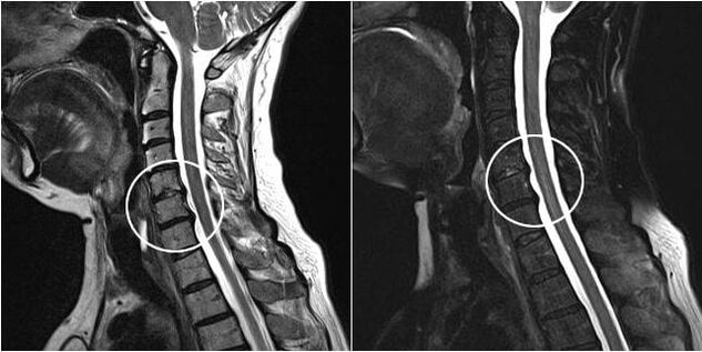 MRI of the cervical spine
