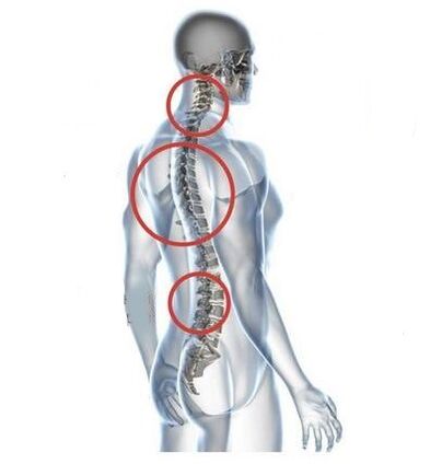 Sites of spinal osteochondrosis