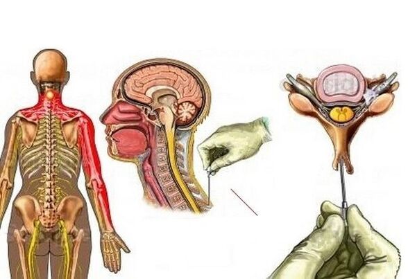 Treatment of cervical osteochondrosis with acupuncture