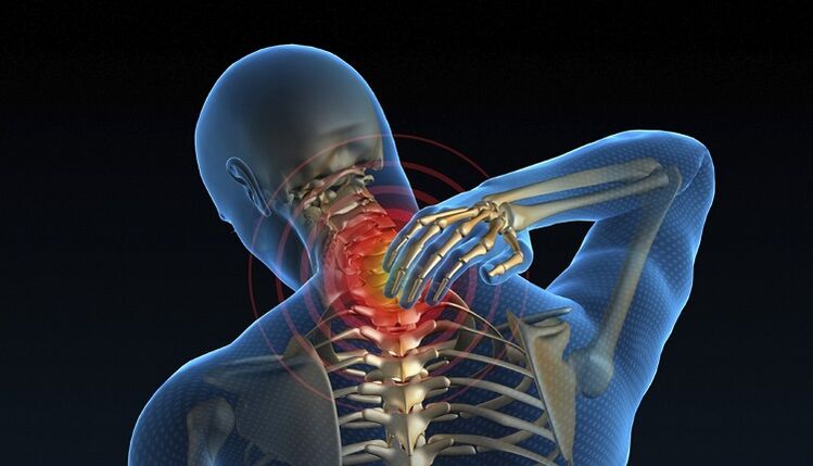 Pinched nerve in the spine as a cause of lower back pain