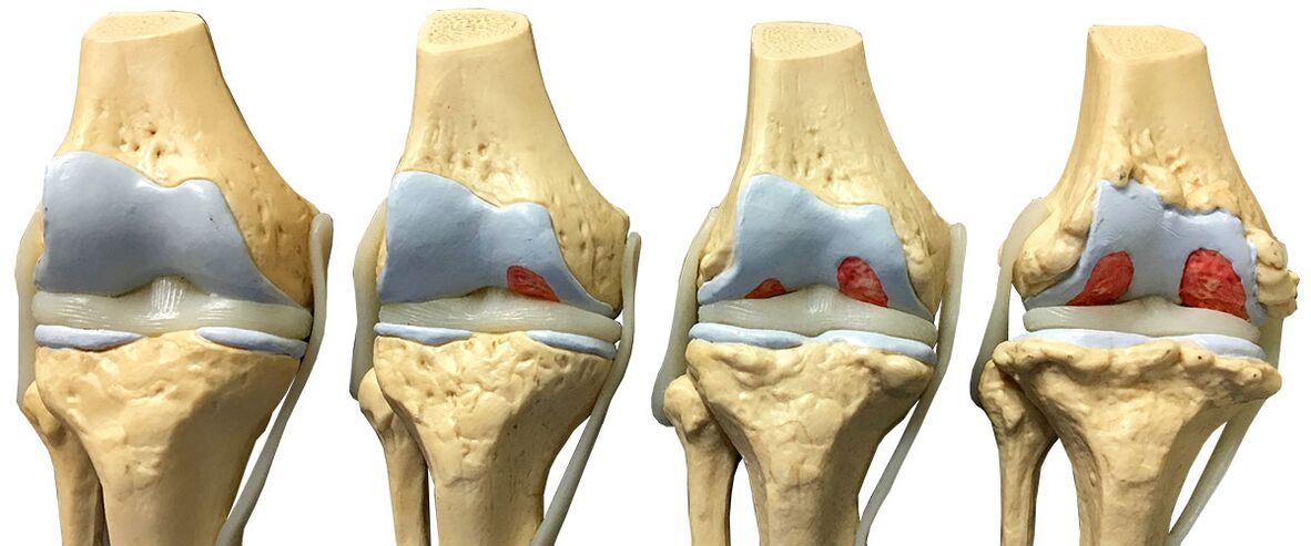 Stages of osteoarthritis