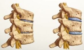 What does osteochondrosis look like